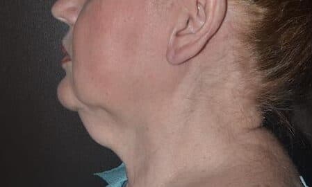 neck lift before