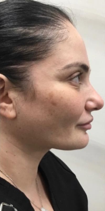 neck lipo after