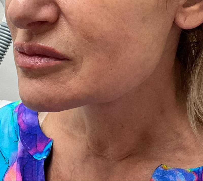 neck lift after