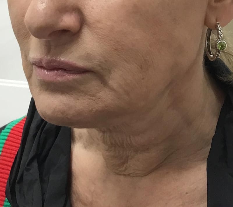 neck lift before