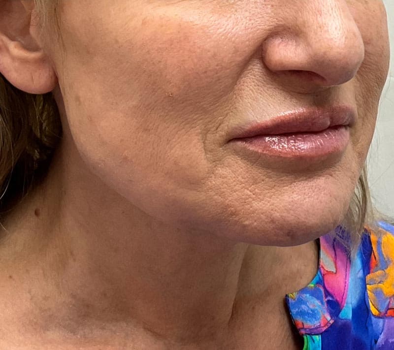 neck lift after