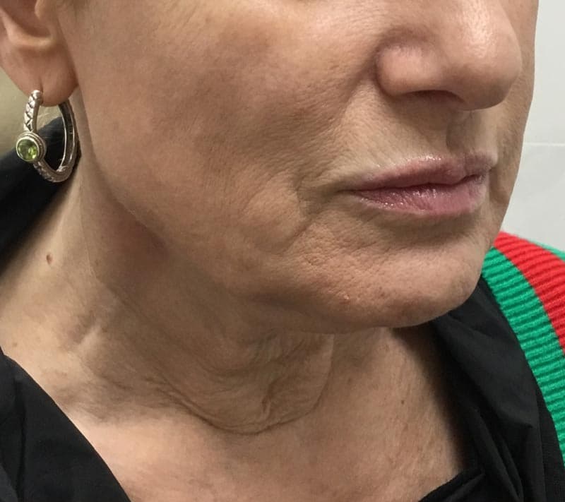 neck lift before