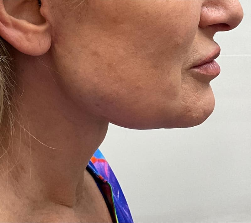 neck lift after