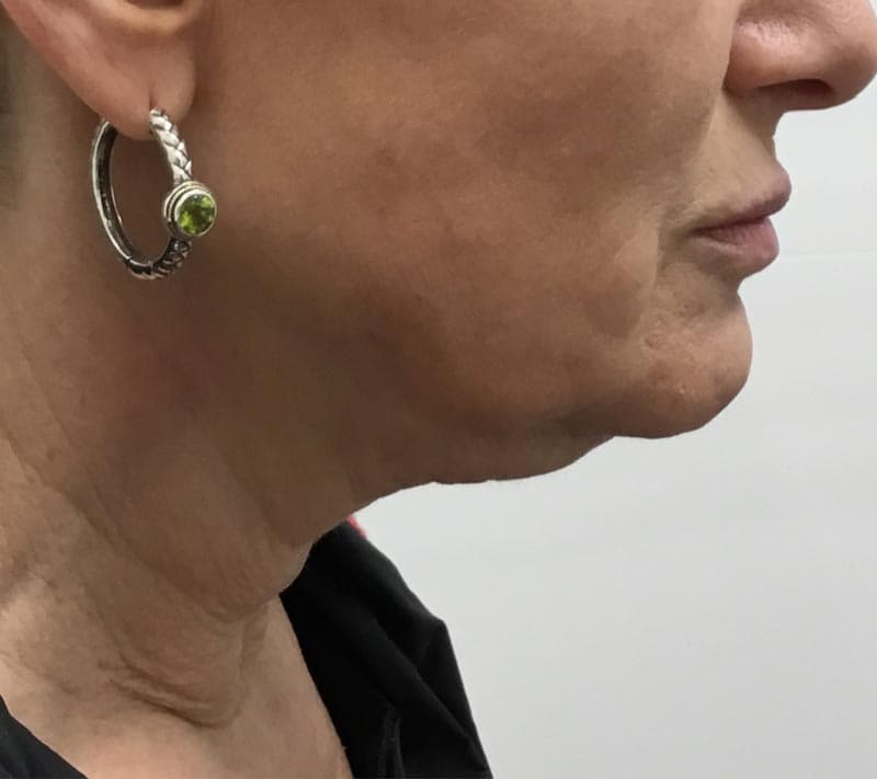 neck lift before