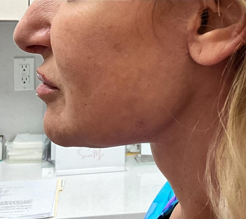 neck lift after