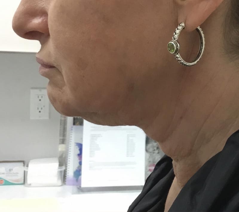 neck lift before
