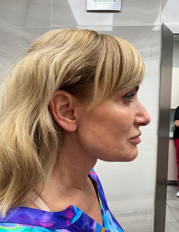 neck lift after