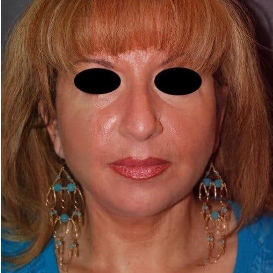 neck lift after