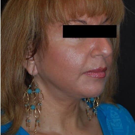 neck lift before