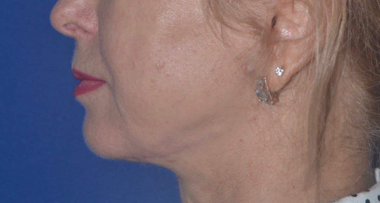 neck lift after
