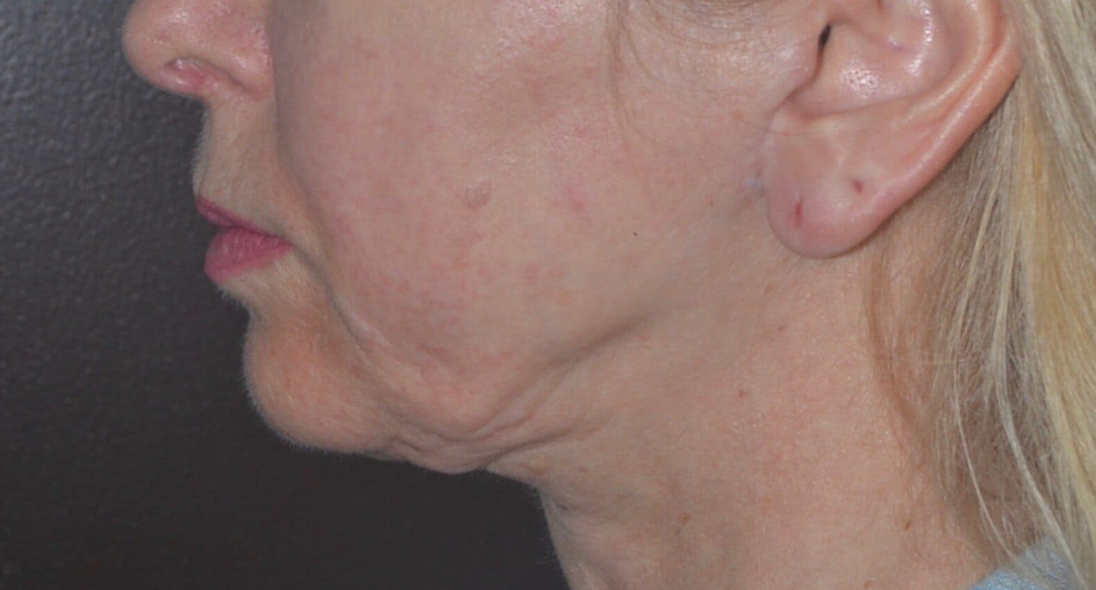 neck lift before