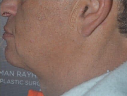 neck lift after