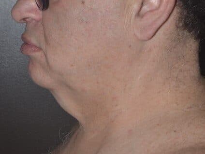 neck lift before