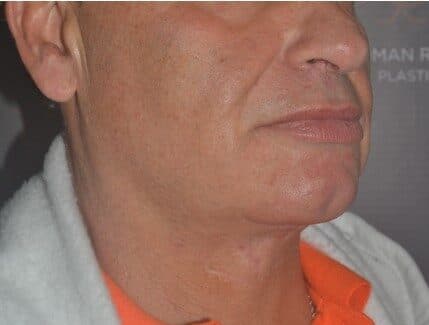 neck lift after