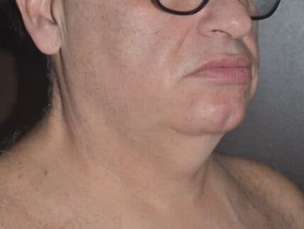 neck lift before