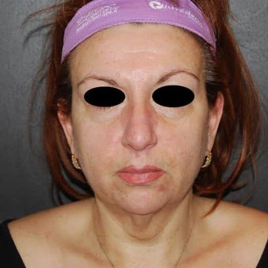 neck lift after