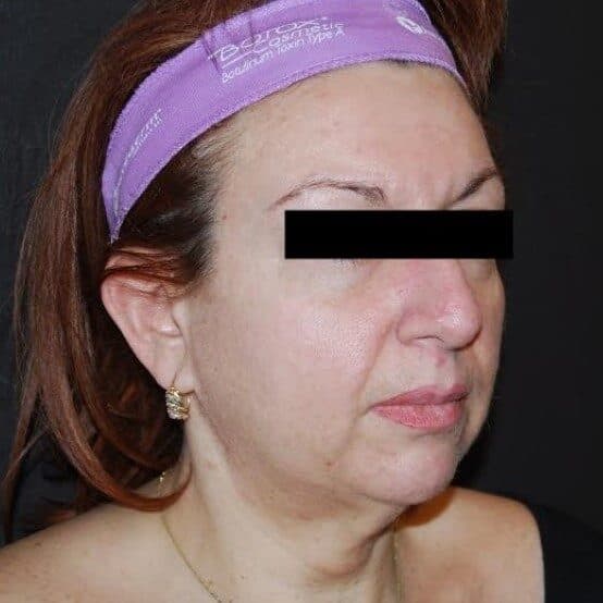 neck lift before