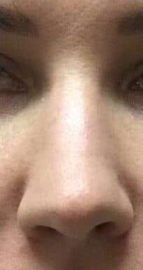 nose filler after