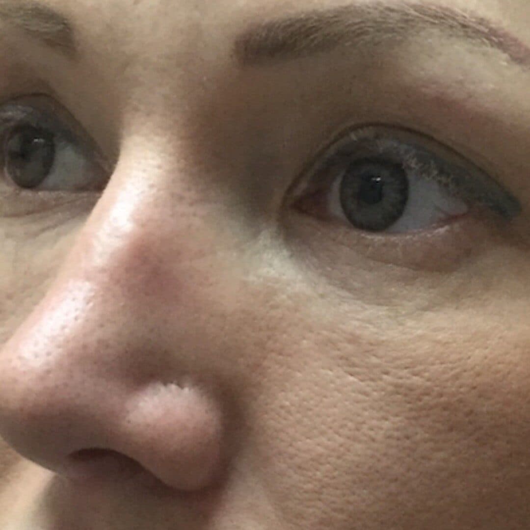 nose filler before