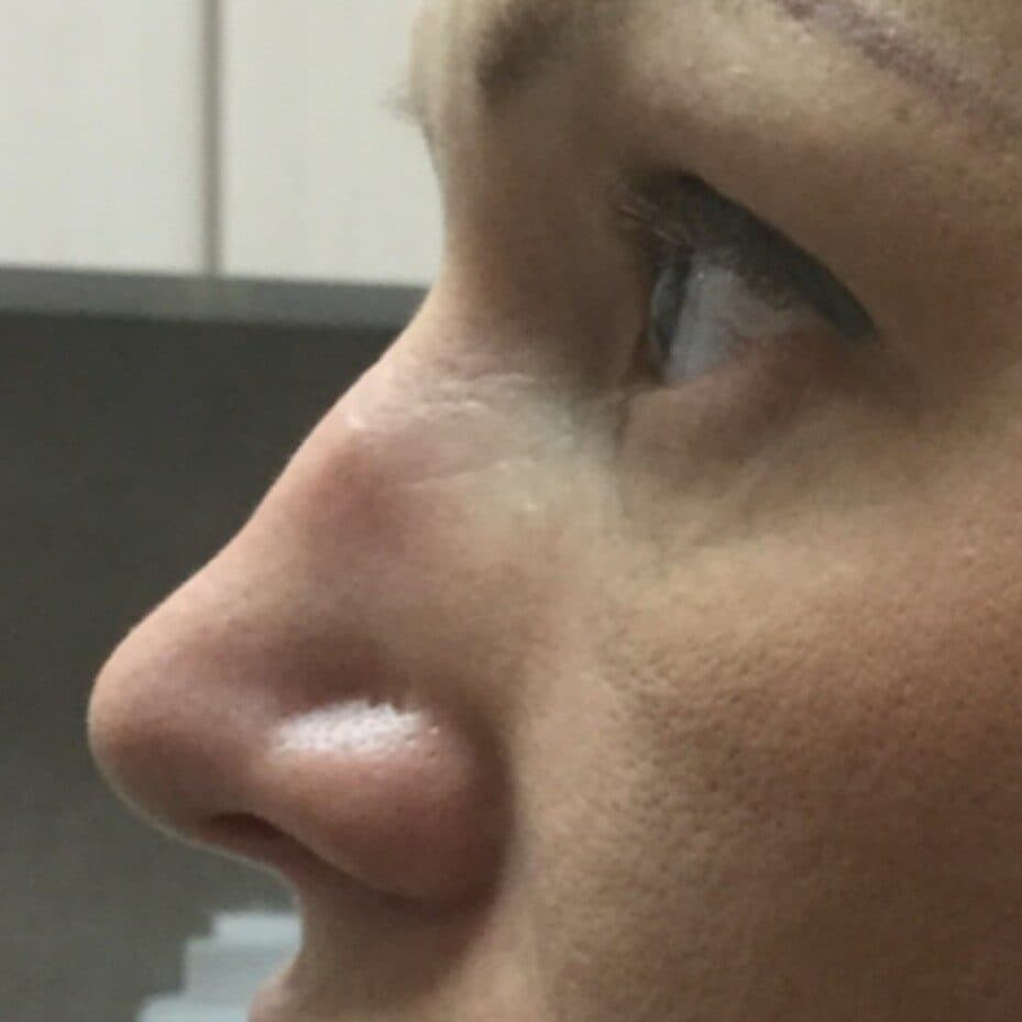 nose filler before