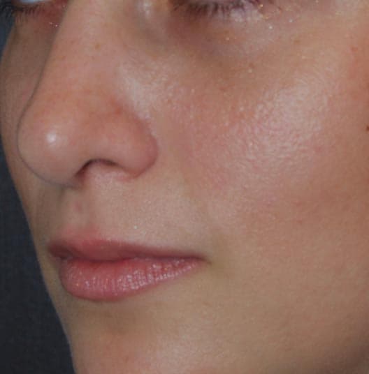 rhinoplasty after