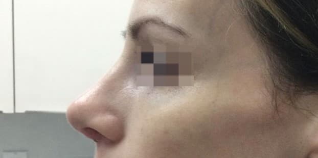 rhinoplasty after
