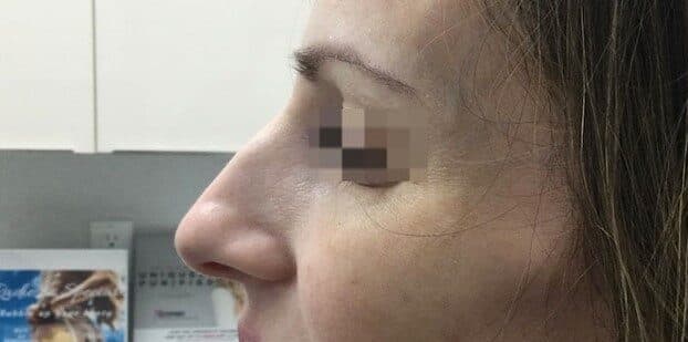 rhinoplasty before
