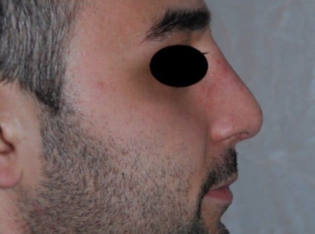 rhinoplasty after