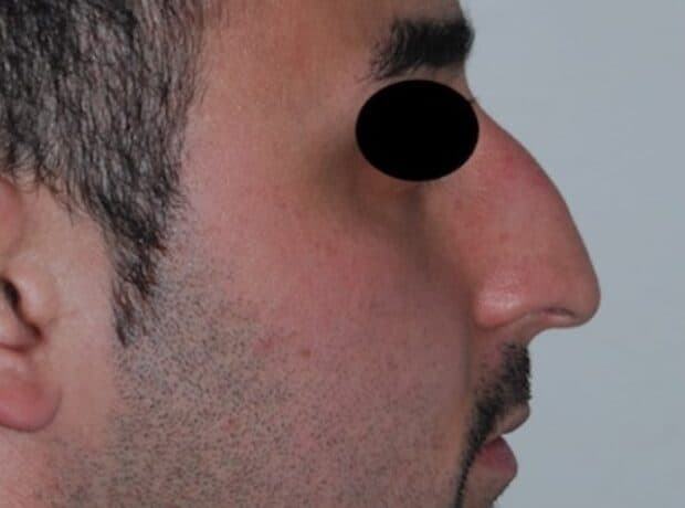 rhinoplasty before