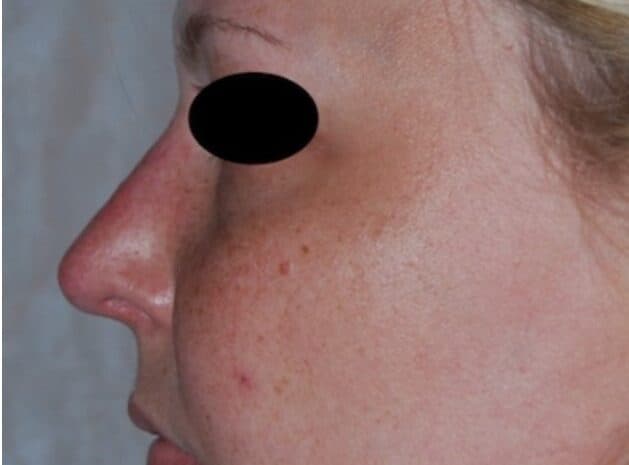 rhinoplasty after