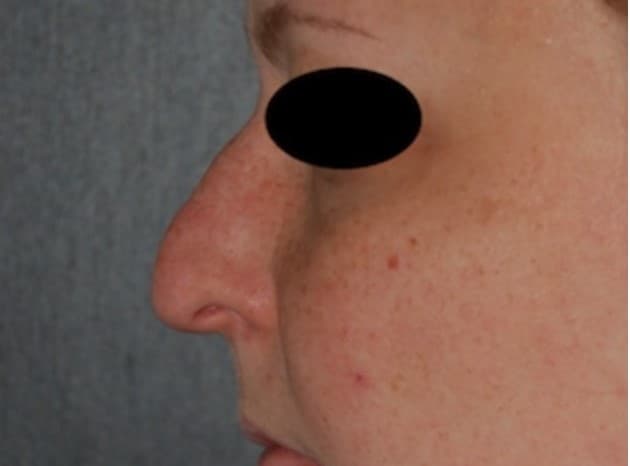 rhinoplasty before