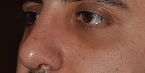 rhinoplasty after