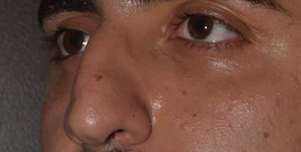 rhinoplasty before