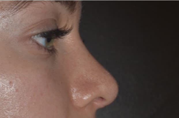 rhinoplasty after