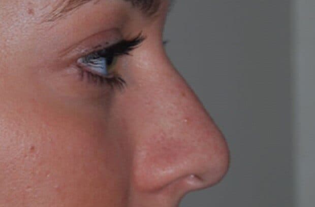 rhinoplasty before