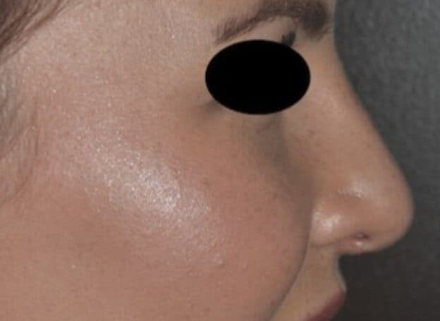 rhinoplasty after