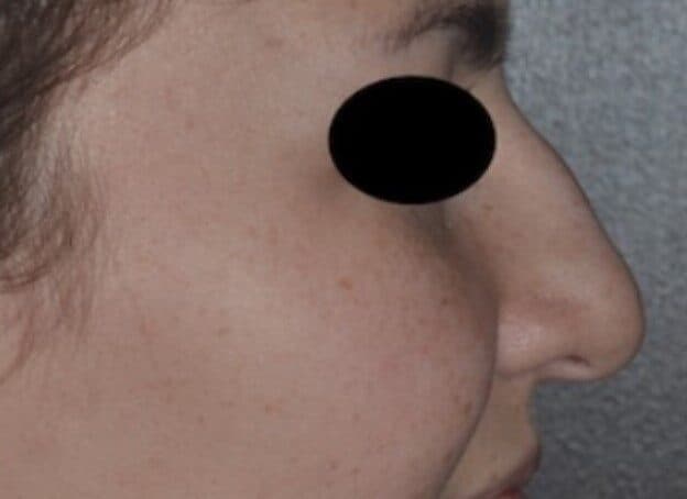 rhinoplasty before