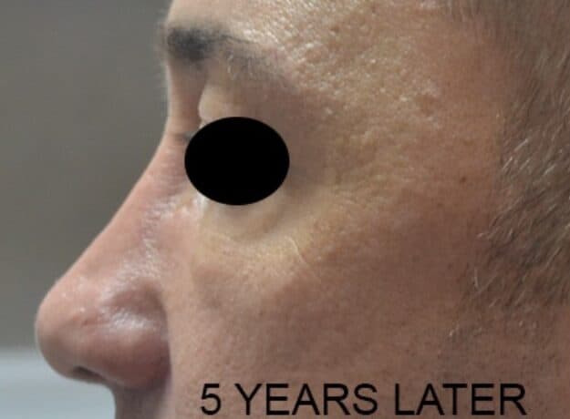 rhinoplasty after