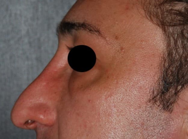 rhinoplasty before