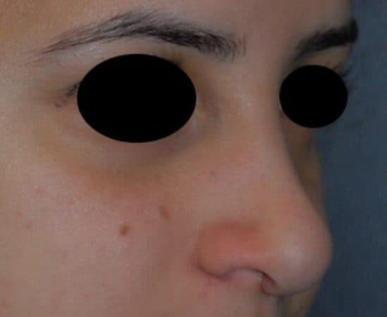 rhinoplasty after