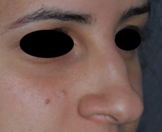 rhinoplasty before