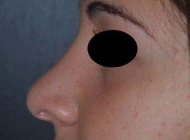 rhinoplasty after