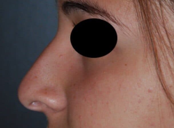 rhinoplasty before