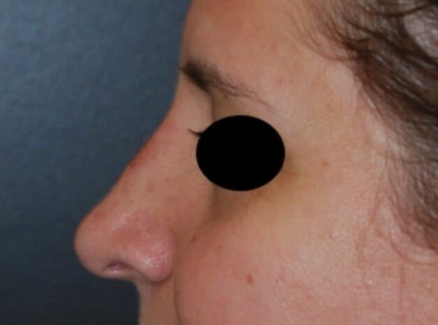 rhinoplasty after