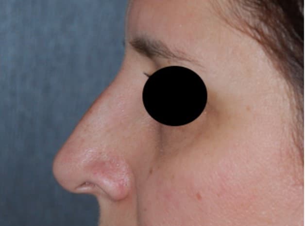 rhinoplasty before