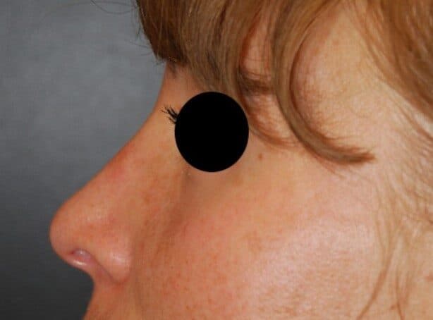 rhinoplasty after