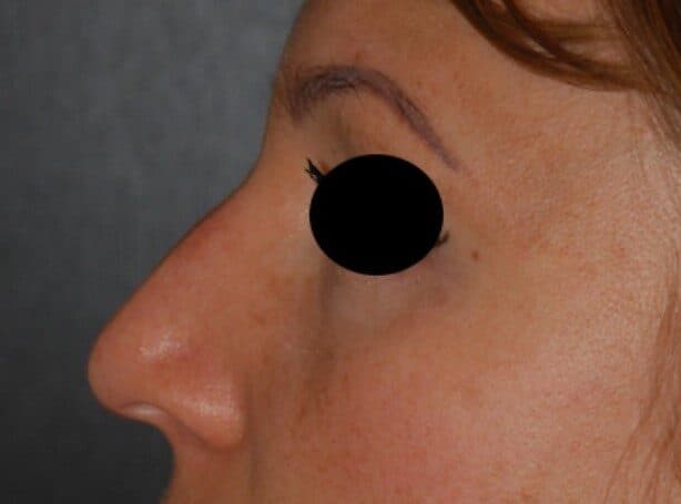 rhinoplasty before