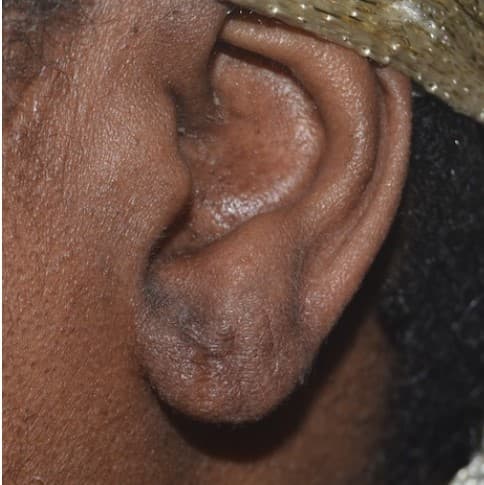 torn earlobe repair after