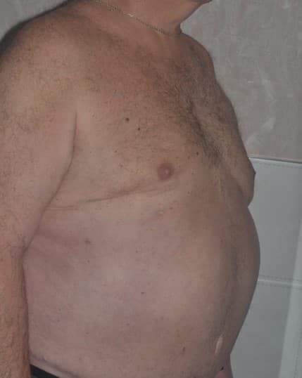 tummy tuck after