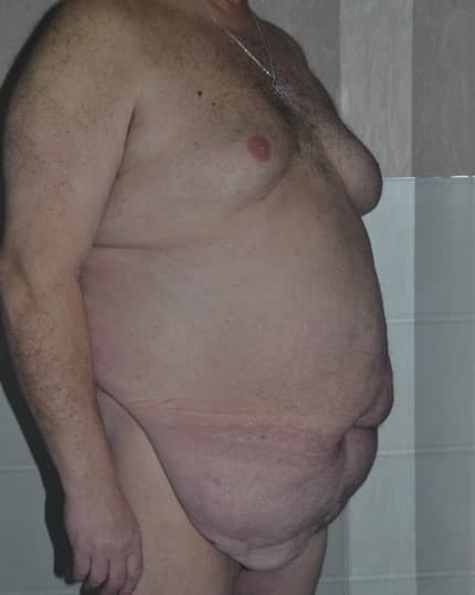 tummy tuck before